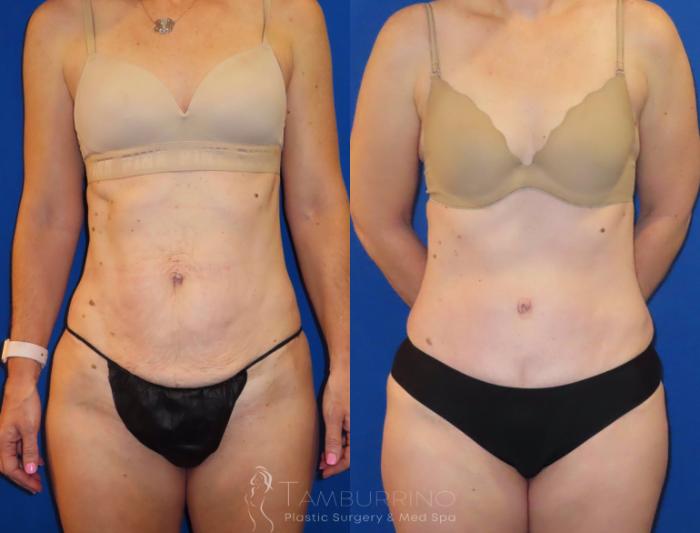 Before & After Tummy Tuck Case 34
