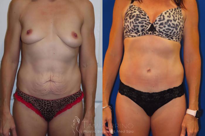 Before & After Tummy Tuck Case 35
