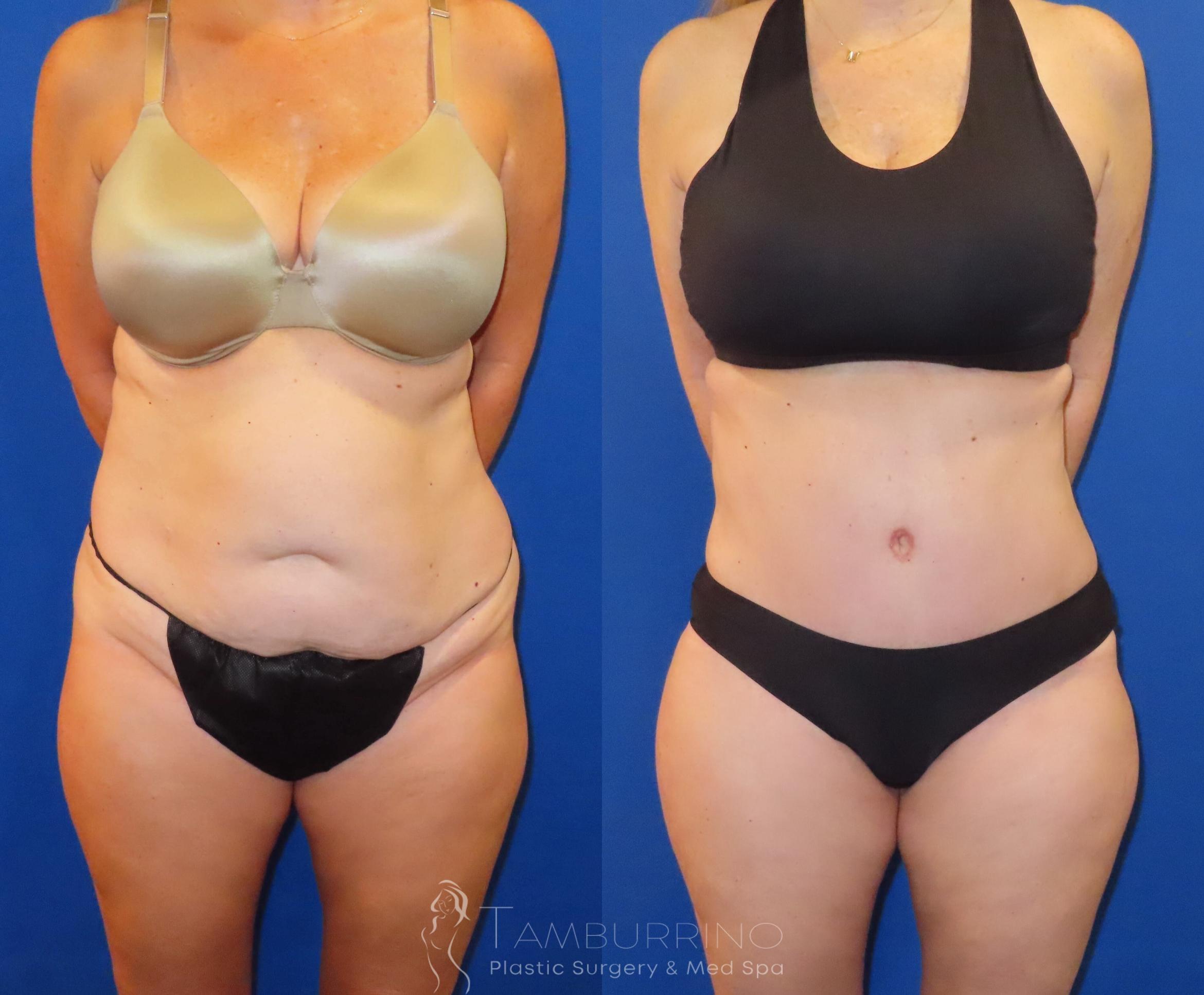 Before & After Tummy Tuck Case 60 Front View in Doylestown, PA