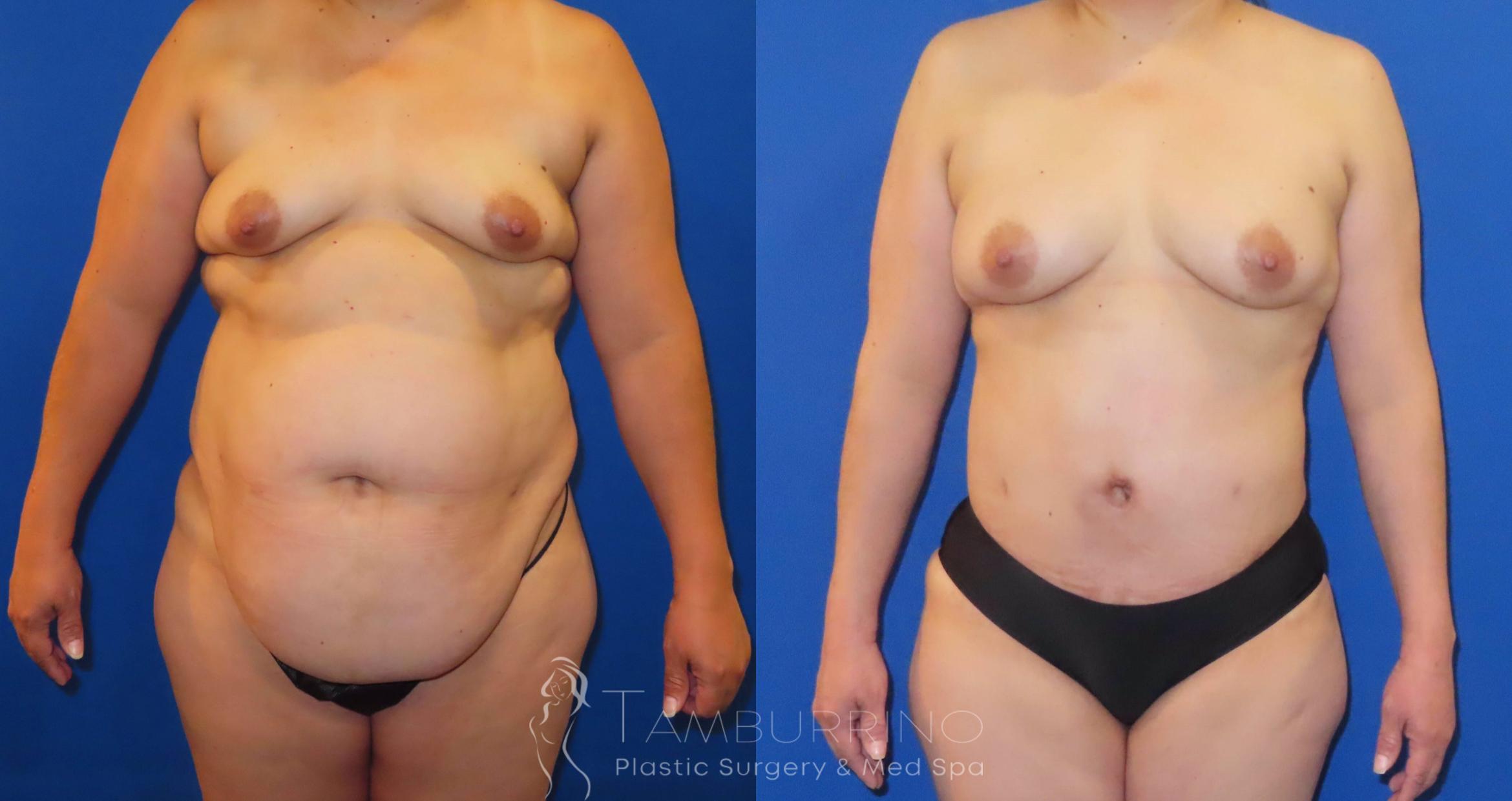 Before & After Tummy Tuck Case 64 Frontal View in Doylestown, PA