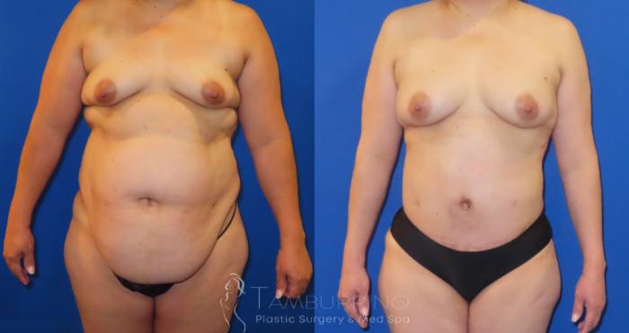 Fat Transfer Before and After