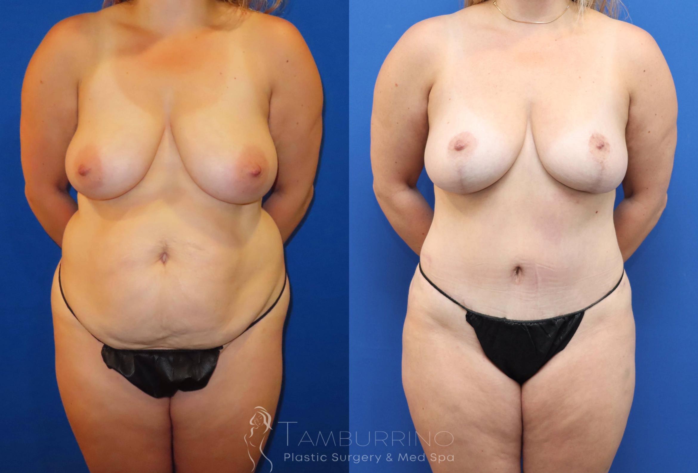 Before & After Tummy Tuck Case 67 Frontal View in Doylestown, PA