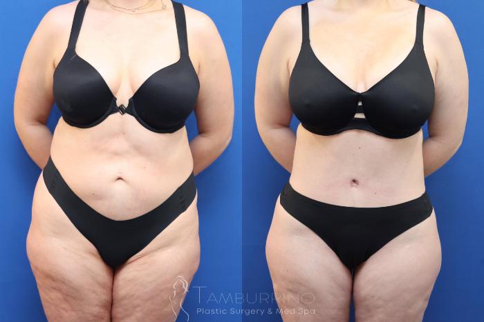 Before & After Tummy Tuck Case 81
