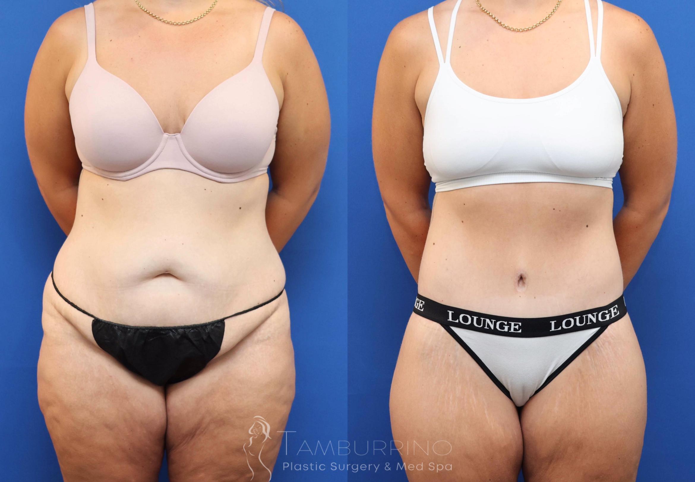 Before & After Tummy Tuck Case 83 Front View in Doylestown, PA