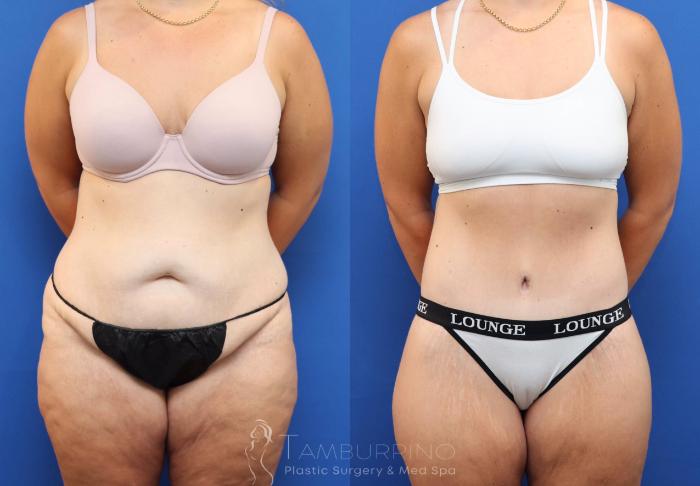 Before & After Tummy Tuck Case 83