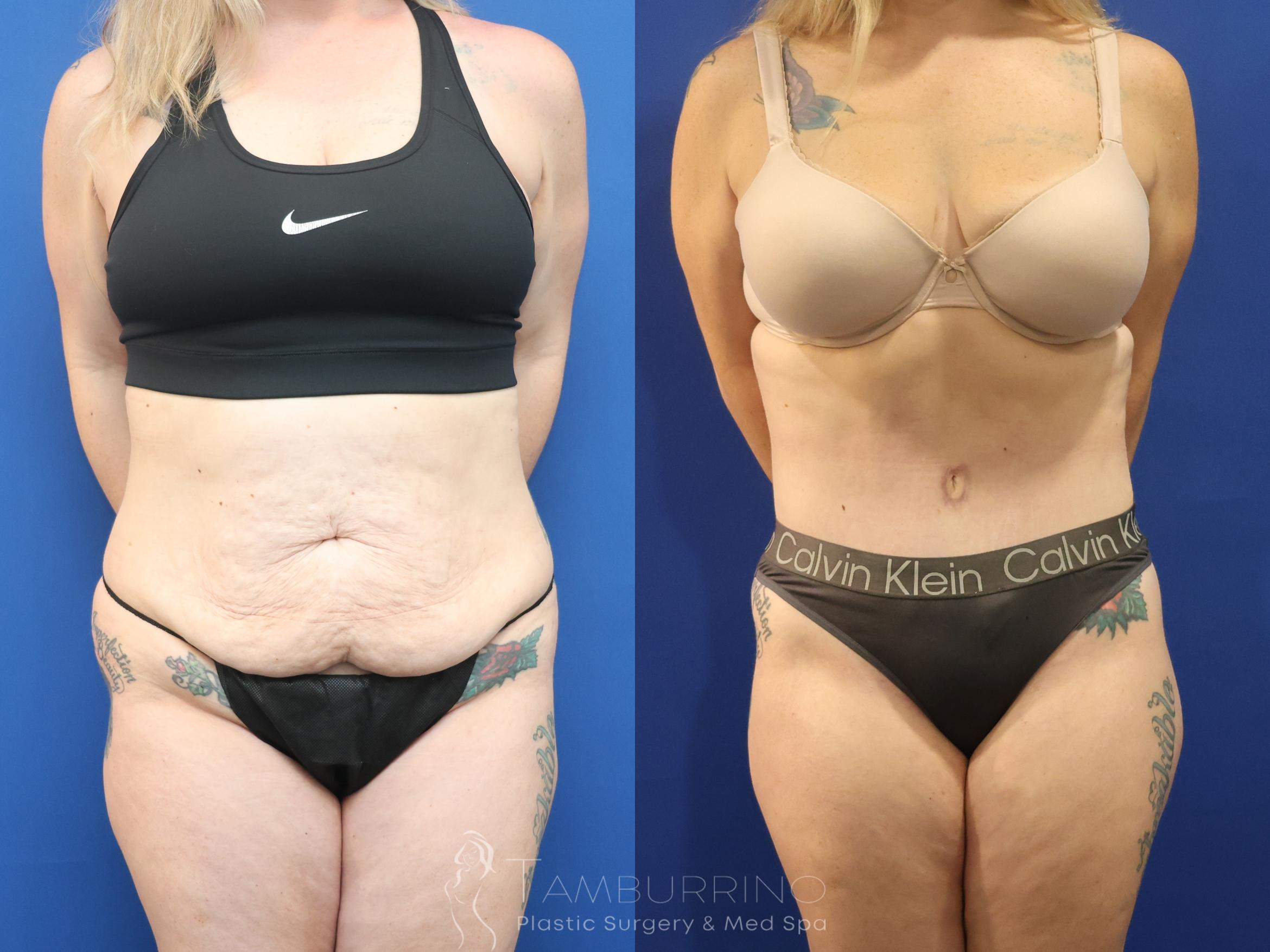 Before & After Tummy Tuck Case 86 Front View in Doylestown, PA