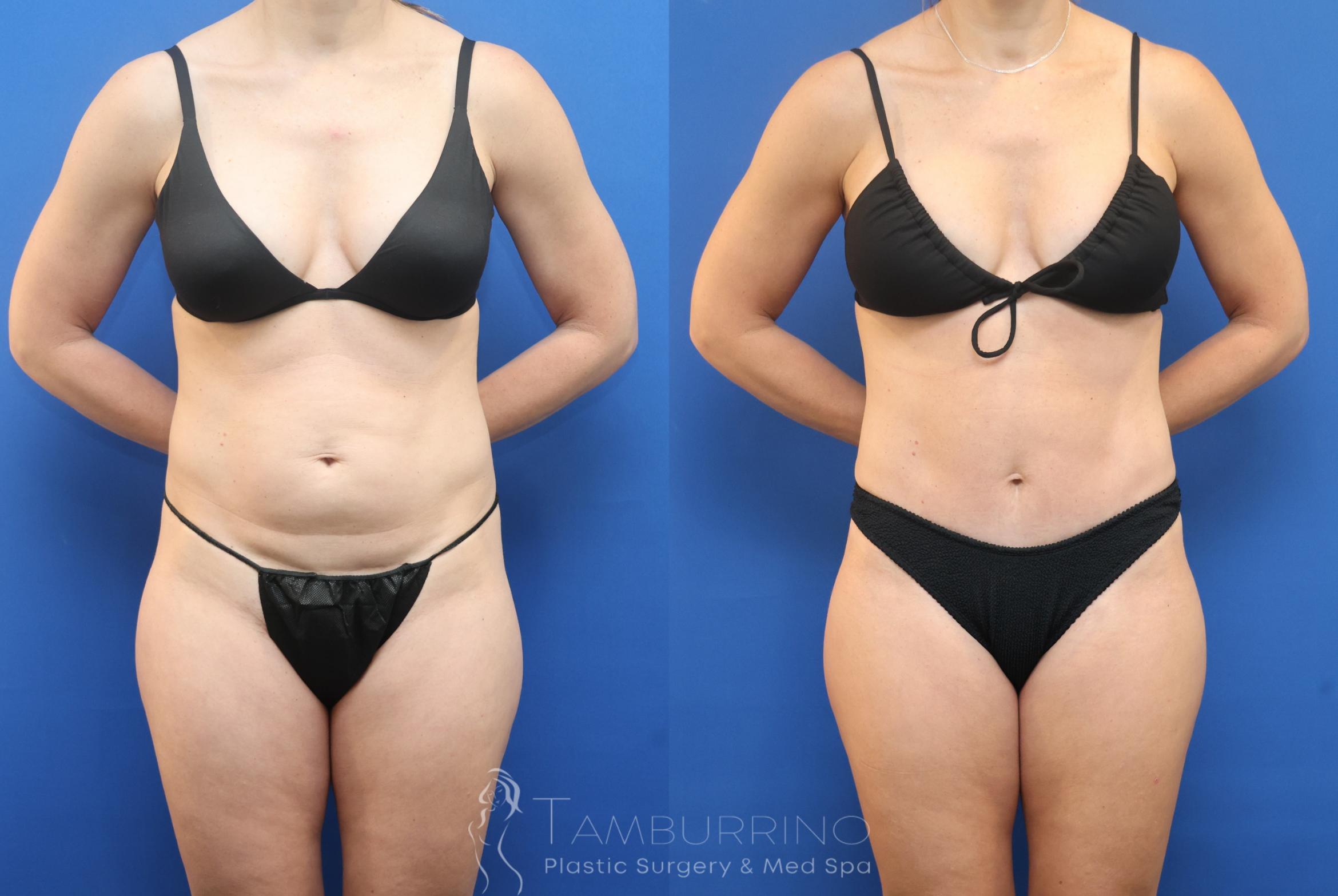 Before & After Tummy Tuck Case 89 Front View in Doylestown, PA