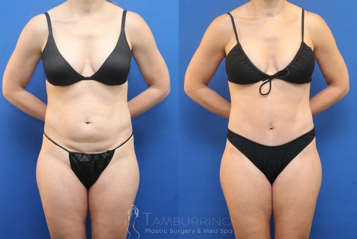 Before & After Tummy Tuck Case 89