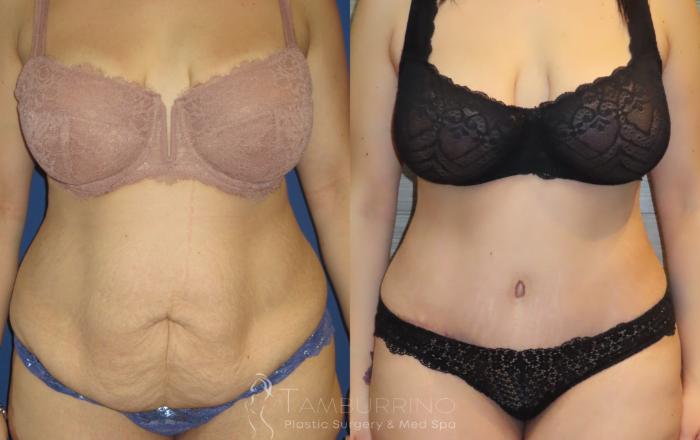 Tummy Tuck Before and After