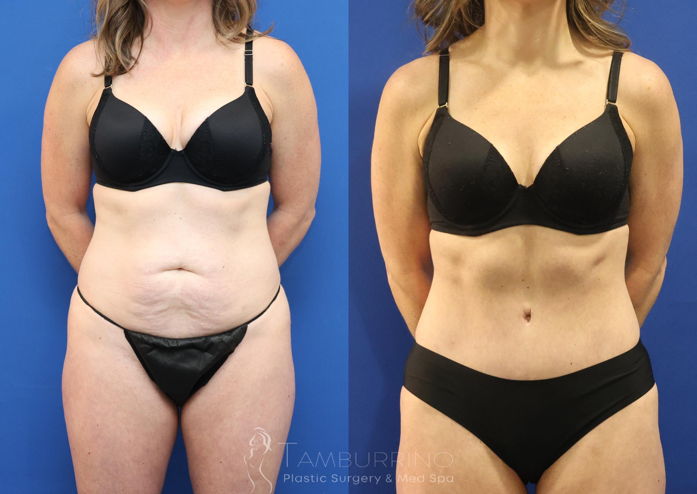 Before & After Tummy Tuck Case 90 Front View in Doylestown, PA