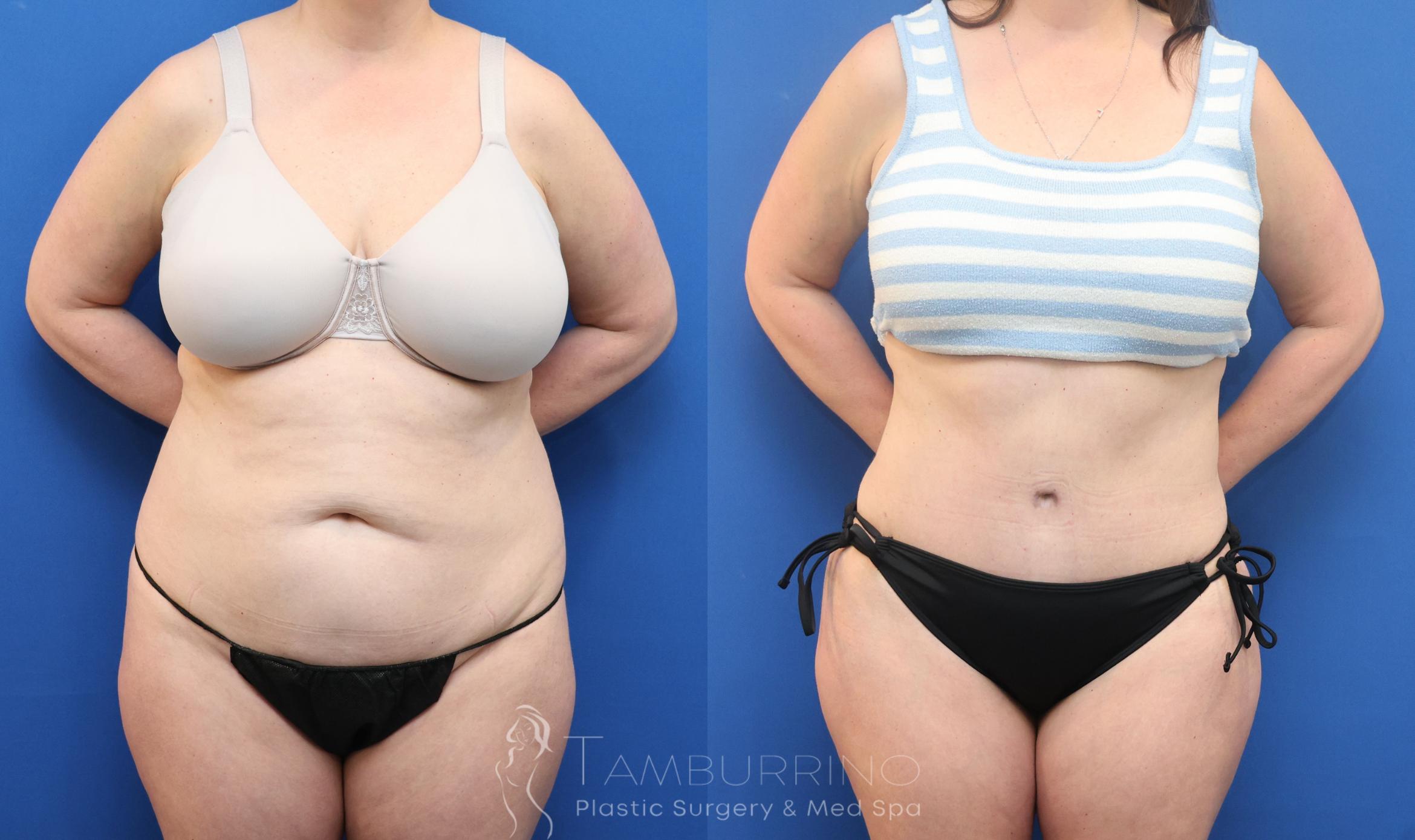 Before & After Tummy Tuck Case 92 Front View in Doylestown, PA
