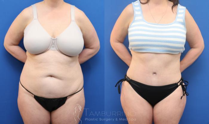 Before & After Tummy Tuck Case 92