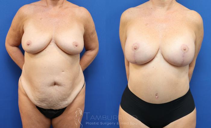 Before & After Tummy Tuck Case 93