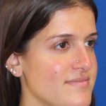 Rhinoplasty Before & After Patient #1454