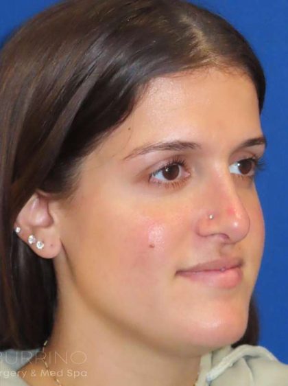 Rhinoplasty Before & After Patient #1454