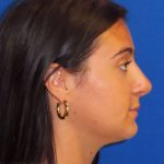 Rhinoplasty Before & After Patient #1465