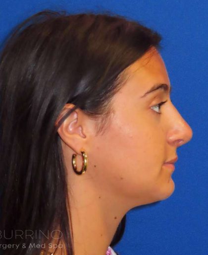 Rhinoplasty Before & After Patient #1465