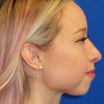 Rhinoplasty Before & After Patient #1476