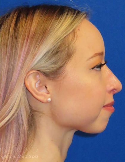 Rhinoplasty Before & After Patient #1476