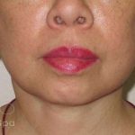 Neck Lift Before & After Patient #1498