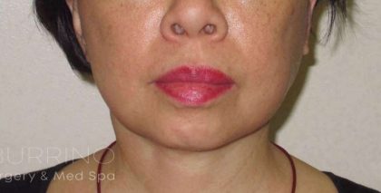 Neck Lift Before & After Patient #1498
