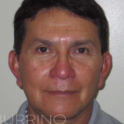Neck Lift Before & After Patient #1520