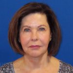 Neck Lift Before & After Patient #1578