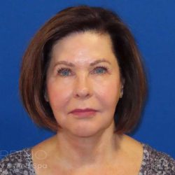 Neck Lift Before & After Patient #1578