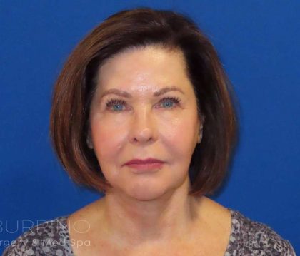 Neck Lift Before & After Patient #1578