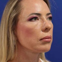 Facelift Before & After Patient #1609