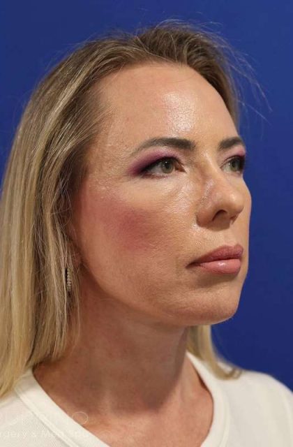 Facelift Before & After Patient #1609