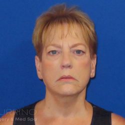 Facelift Before & After Patient #1620