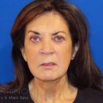 Facelift Before & After Patient #1631