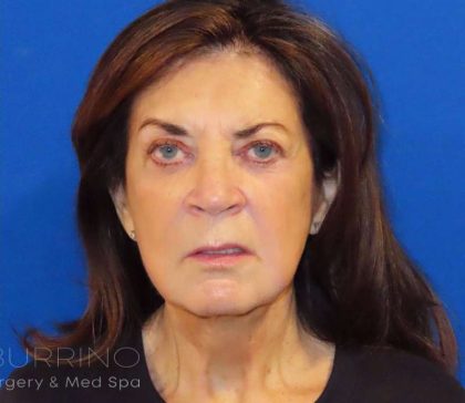 Facelift Before & After Patient #1631