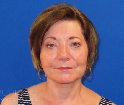 Facelift Before & After Patient #1642
