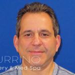 Facelift Before & After Patient #1653