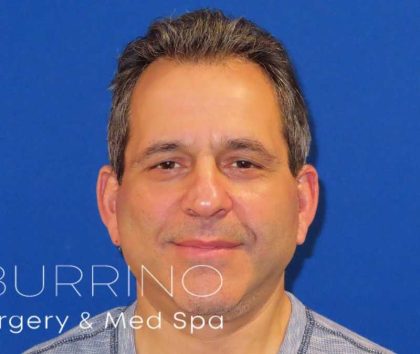 Facelift Before & After Patient #1653