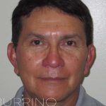 Facelift Before & After Patient #1664