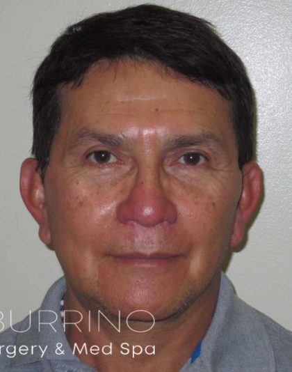 Facelift Before & After Patient #1664