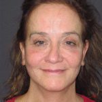 Facelift Before & After Patient #1682