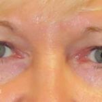 Eyelid Lift Before & After Patient #1703