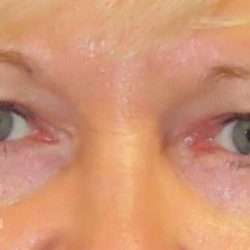Eyelid Lift Before & After Patient #1703