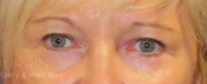 Eyelid Lift Before & After Patient #1703