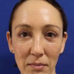 Eyelid Lift Before & After Patient #1708