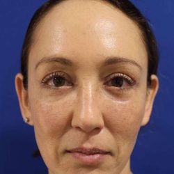 Eyelid Lift Before & After Patient #1708