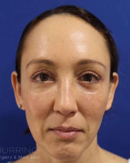 Eyelid Lift Before & After Patient #1708
