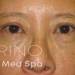 Eyelid Lift Before & After Patient #1711