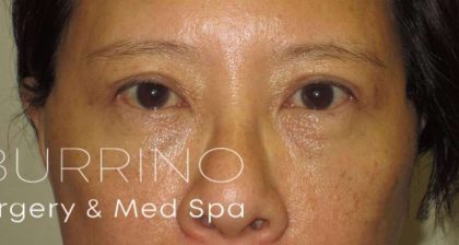 Eyelid Lift Before & After Patient #1711