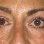 Eyelid Lift Before & After Patient #1714