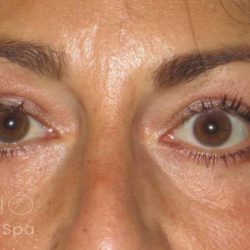 Eyelid Lift Before & After Patient #1714
